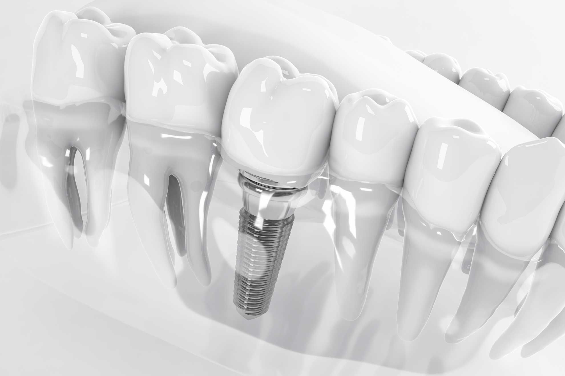 Implantes Dentales Barcelona
